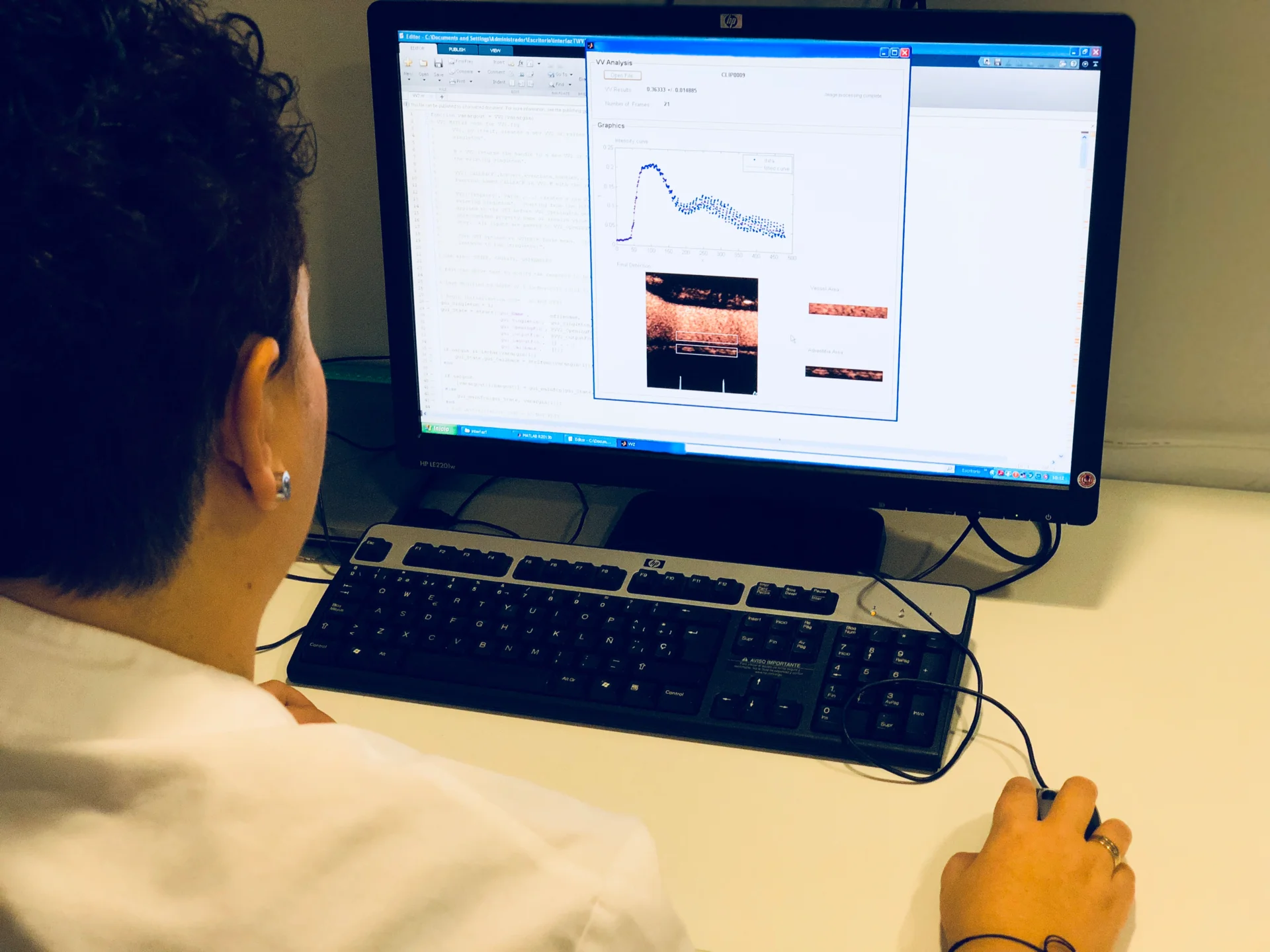Researchers from Lleida create the first automatic program to measure the small blood vessels that supply the arteries