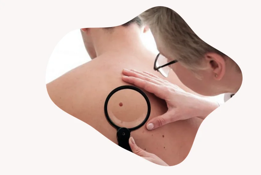 Five dermatology specialists from Lleida take part in the Euromelanoma 2022 skin cancer campaign
