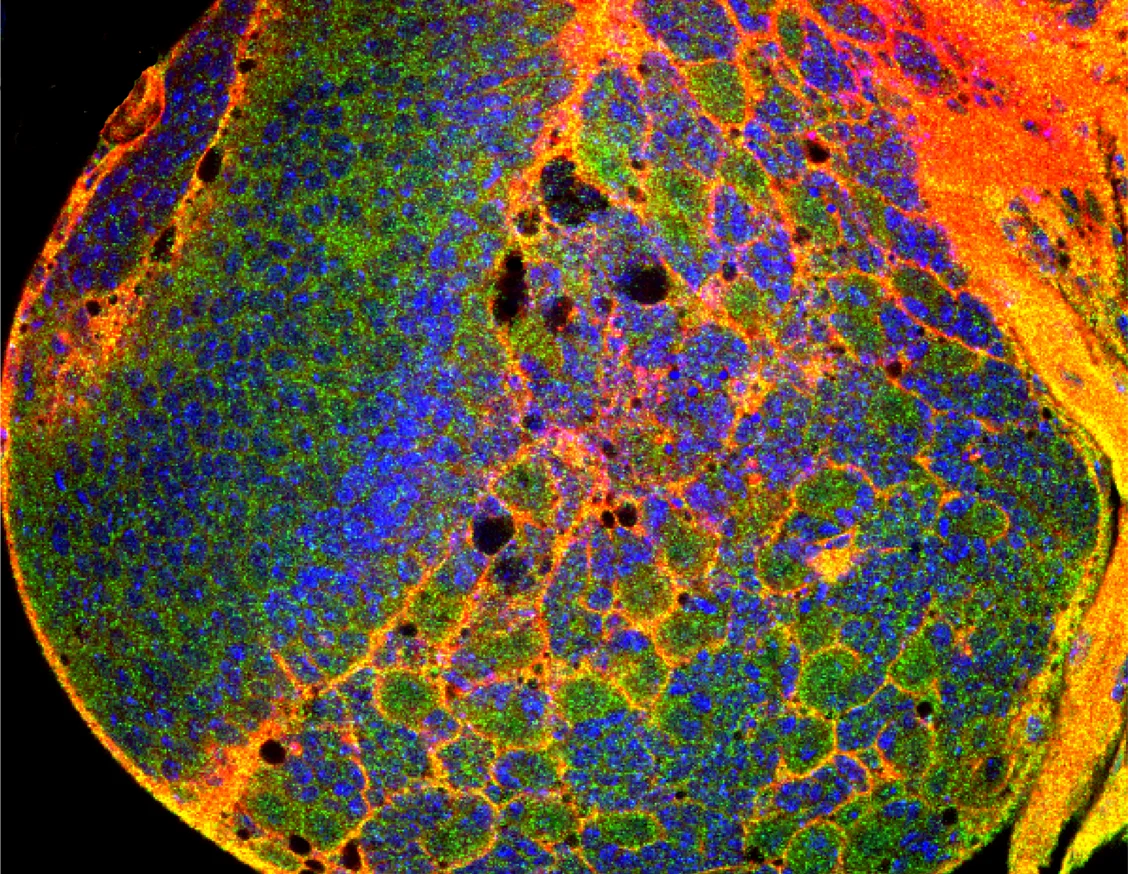 A study using a glioma model in fruit flies identifies a new potential therapeutic target against glioblastoma