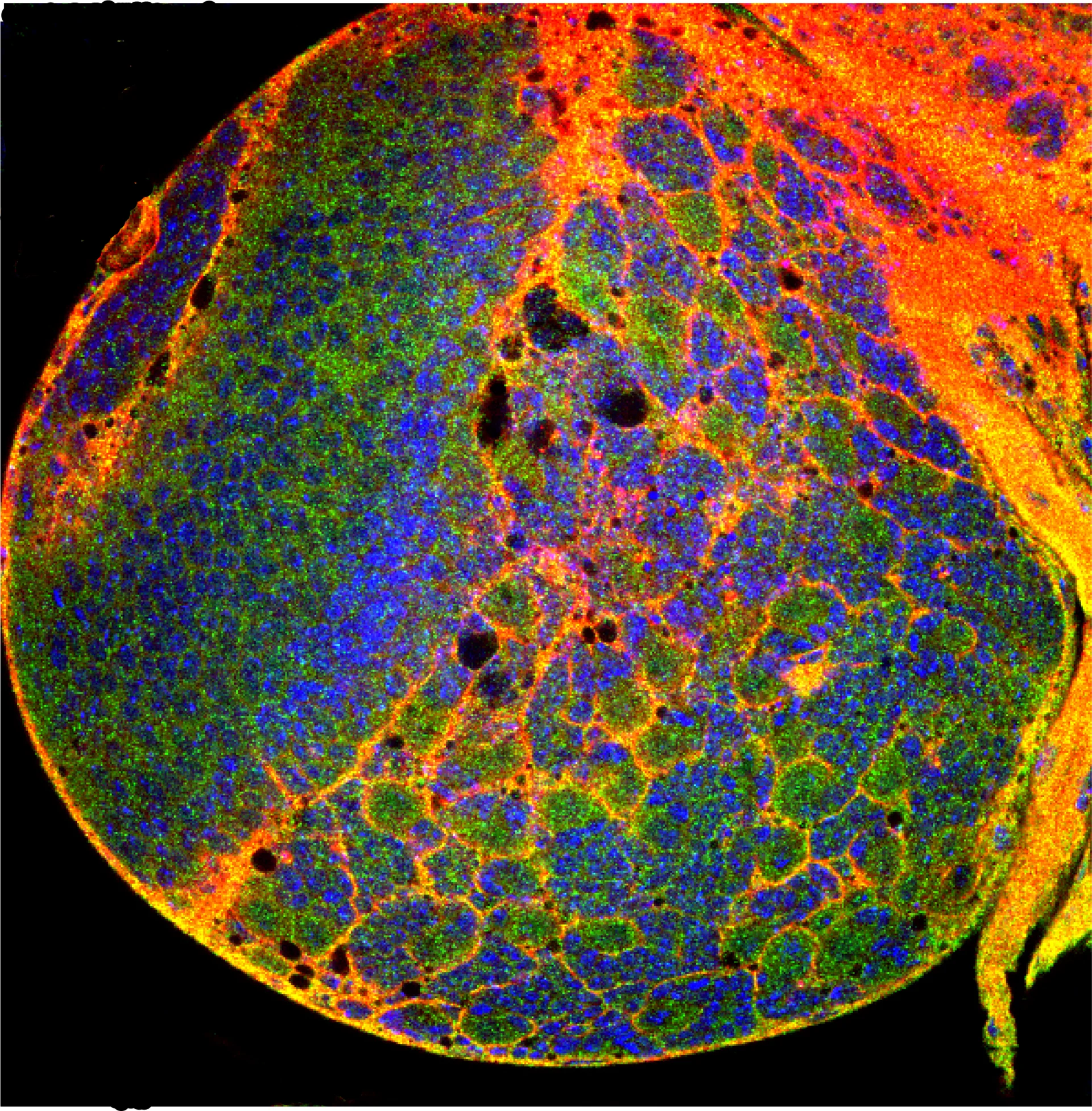 Un estudio usando un modelo de glioma en moscas de la fruta identifica una nueva diana terapéutica potencial contra el glioblastoma